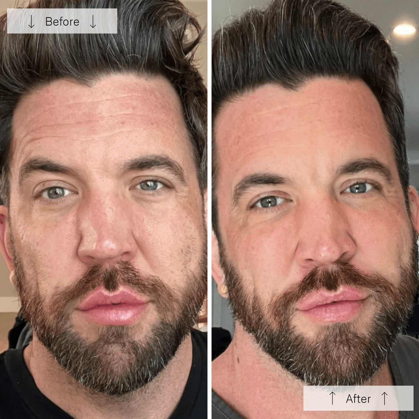 Omnilux Mens LED Face Mask + Bonus Ampoules