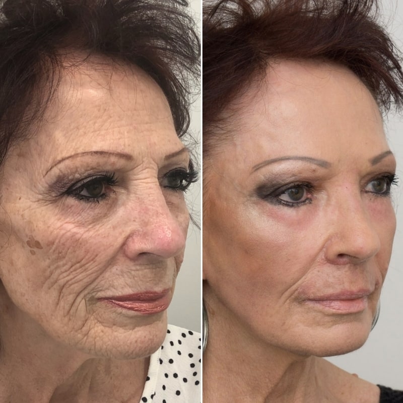 GMC Laser Resurfacing - Consultation