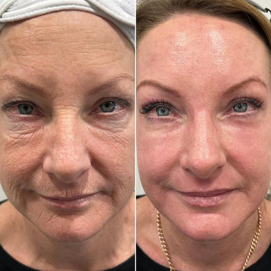 GMC Laser Resurfacing - Consultation
