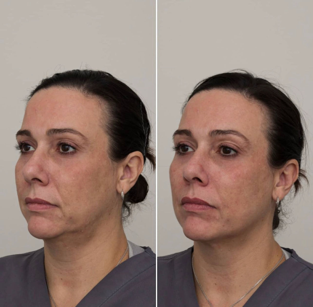 GMC Forma Skin Tightening Treatment Packages