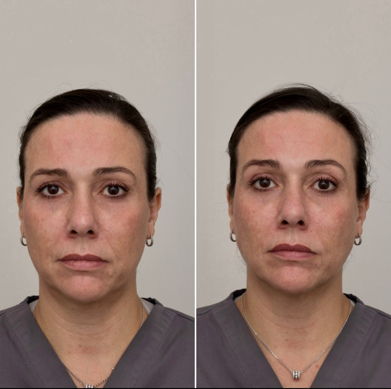 GMC Forma Skin Tightening Treatment Packages