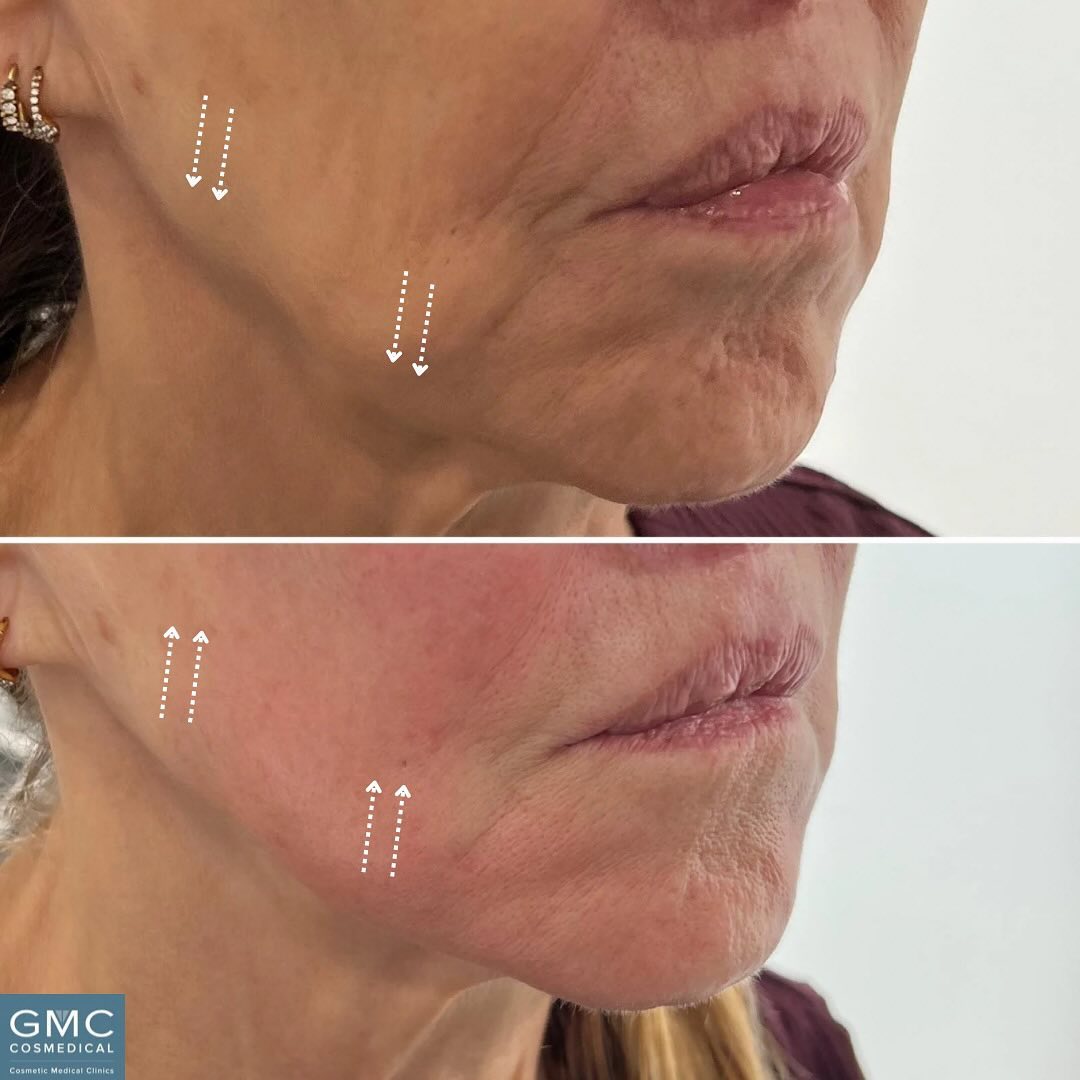 GMC Forma Skin Tightening Treatment Packages