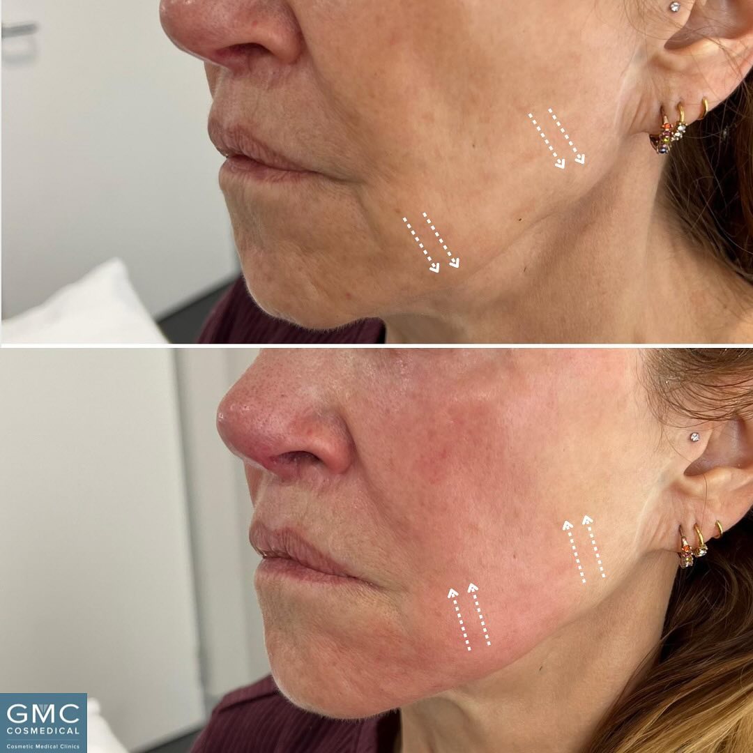 GMC Forma Skin Tightening Treatment Packages