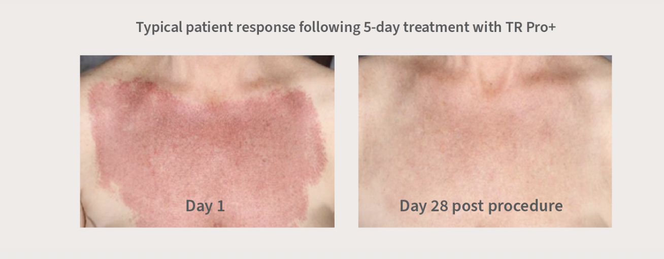 TR Pro+™ 10g - Post Procedure Gel