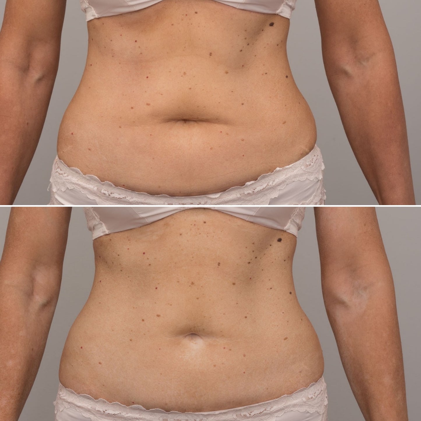 GMC EvolveX Body Contouring Treatment Package