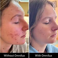 Omnilux Contour Clear LED Face Mask + Bonus Ampoules