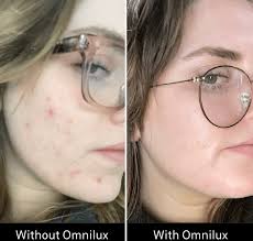 Omnilux Contour Clear LED Face Mask